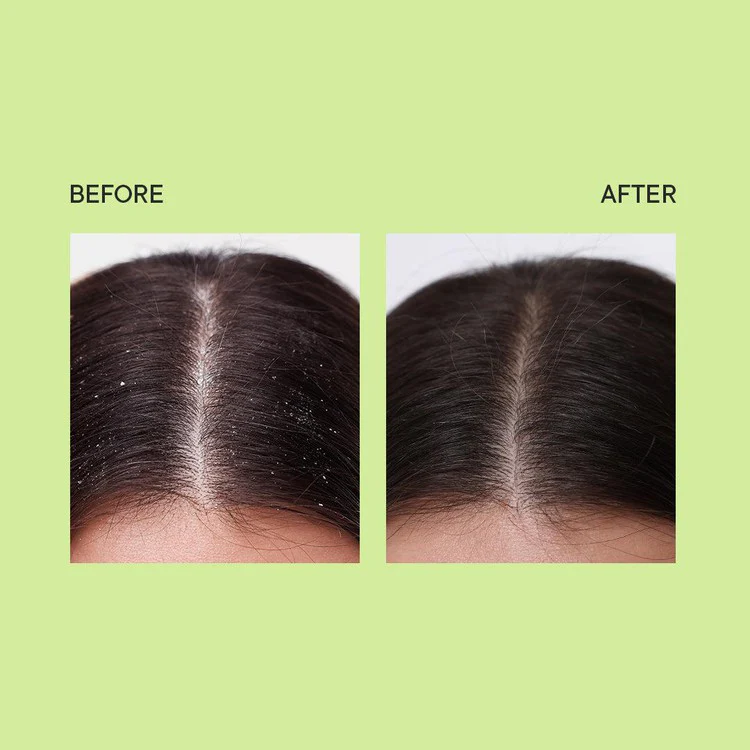 Dandruff Control Ampoule with Tea Tree Extracts - 100 ML - Image 6